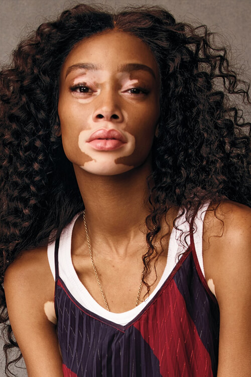 Winnie Harlow Winnie Harlow
